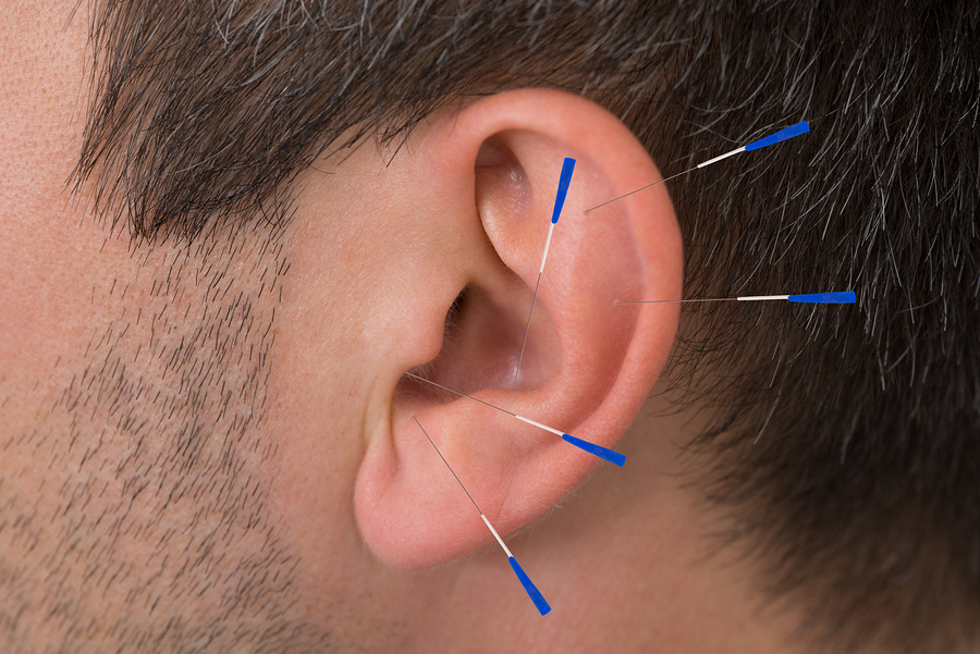 Auricular (Ear) Acupuncture